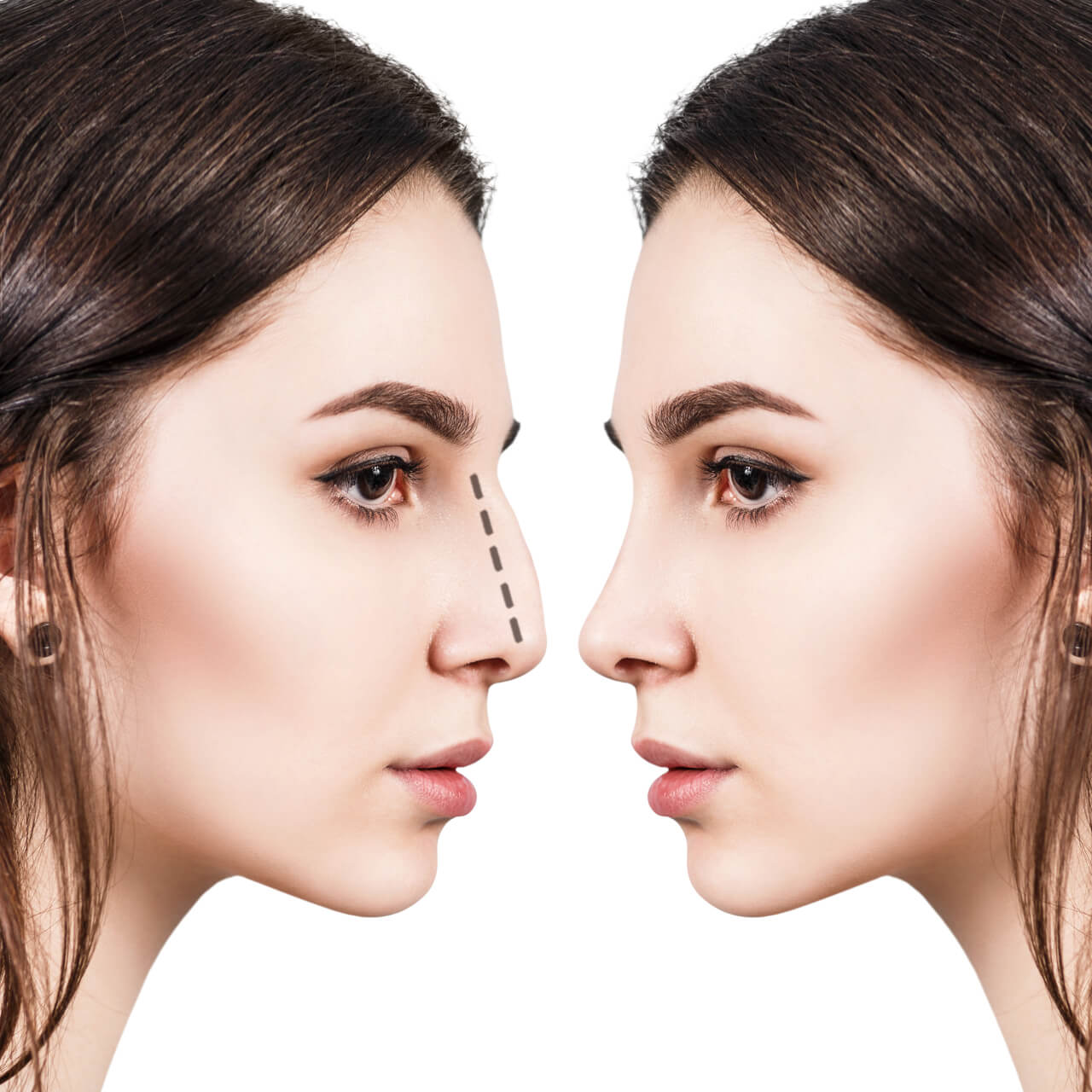 Expert Guide To Nose Job Reviews: What You Need To Know